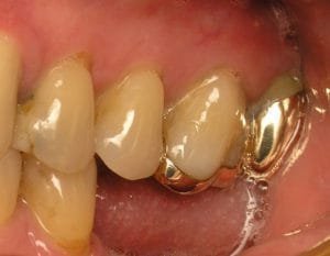 Over erupted upper molars due to missing lower molars