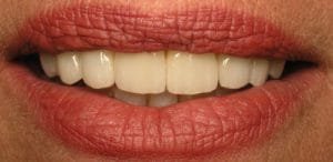 Patient after veneers & Invisalign