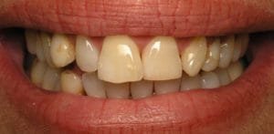 Before veneers and Invisalign