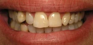 Before veneers and Invisalign