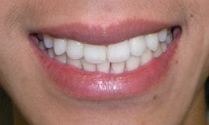 Patient's smile after Invisalign orthodontic treatment