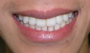 Patient's smile after Invisalign orthodontic treatment