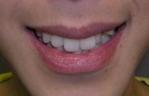 Teen patient before orthodontics