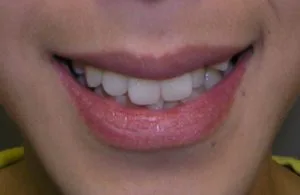 Teen patient before orthodontics