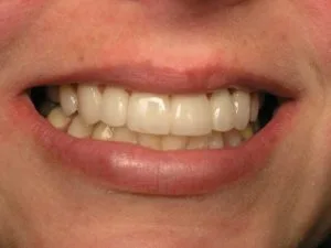 After veneers and sedation dentistry