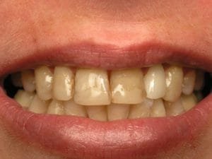 Before veneers and sedation dentistry