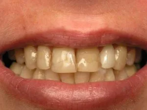 Before veneers and sedation dentistry