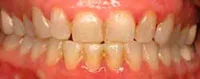 Gingivitis causes red swollen gums