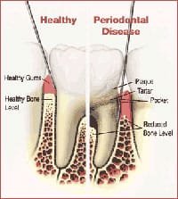 Gum disease has certain signs and symptoms