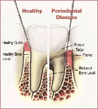 Gum disease has certain signs and symptoms