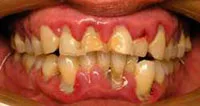 Advanced periodontitis means tooth loss is near
