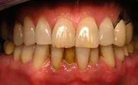 Periodontitis cause bone loss and red gums