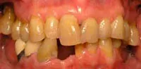 Moderate periodontitis means 50% bone loss