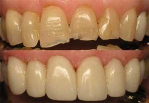 Dental crowns are used to restore worn and broken teeth
