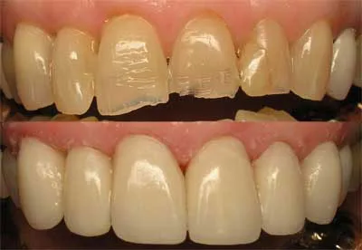 San Marcos dentist uses dental crowns to restore worn and broken teeth