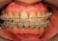 orthodontics and braces for young and old patients