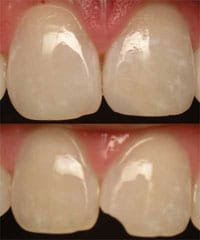 San Marcos dentist uses dental bonding to repair chipped teeth