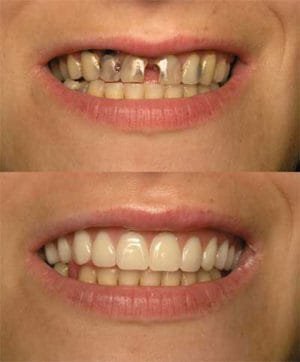 Immediate dentures are placed in right after dental surgery