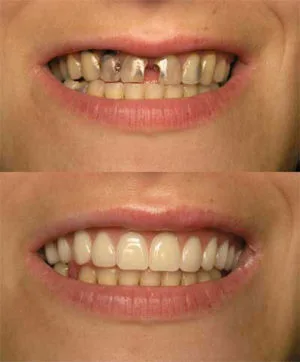 Immediate dentures are placed in right after dental surgery