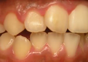 Gum disease treatment does not hurt