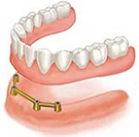 Denture Implants - All On Four San Marcos implant dentist offers Implant dentures for a secure and comfortable feeling.