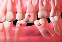 Implant dentist in San Marcos explains problem with tooth loss