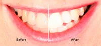 Teeth whitening makes you look younger