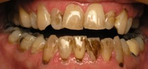 Patient with tooth cavities, root decay, and gum disease 