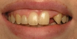 Congenitally missing tooth leaving a big gap in the smile