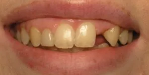 Congenitally missing tooth leaving a big gap in the smile