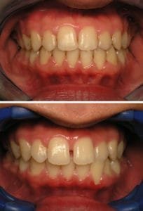 Picture of gapped teeth treated by braces