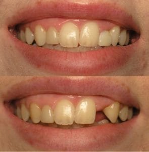 Gap in teeth treated by dental implant image