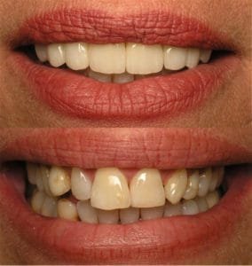 Gaps between teeth treated by cosmetic dentistry