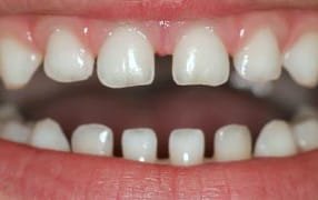 gaps along baby teeth