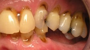 Root cavties, tooth decay, gum recession, tooth eruption seen all in one patient