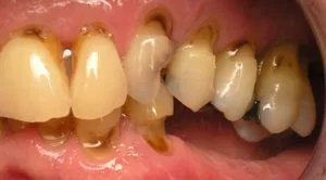 Root cavties, tooth decay, gum recession, tooth eruption seen all in one patient