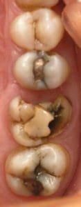 Tooth cavities images of different sizes