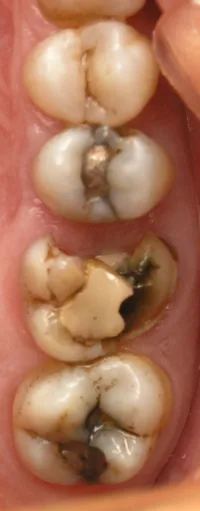 Tooth cavities, black fillings, broken teeth