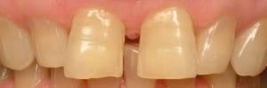 Gapped teeth because of small tooth size