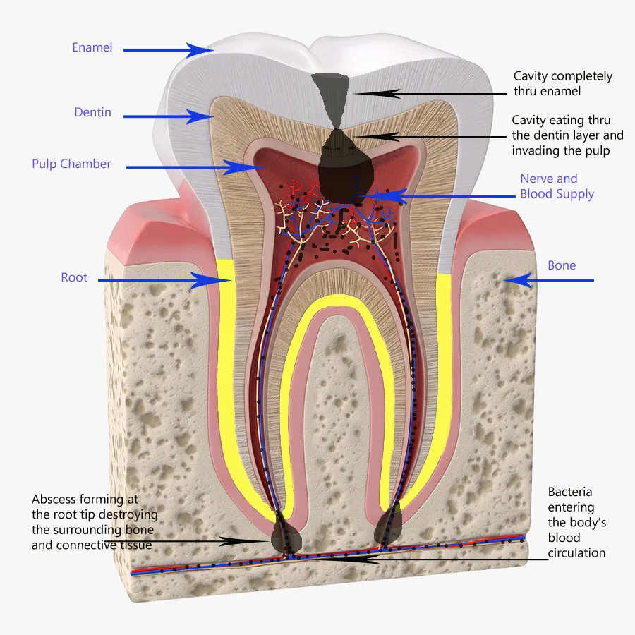 Most Common Teeth Diseases Image of tooth decay causing a dental abscess