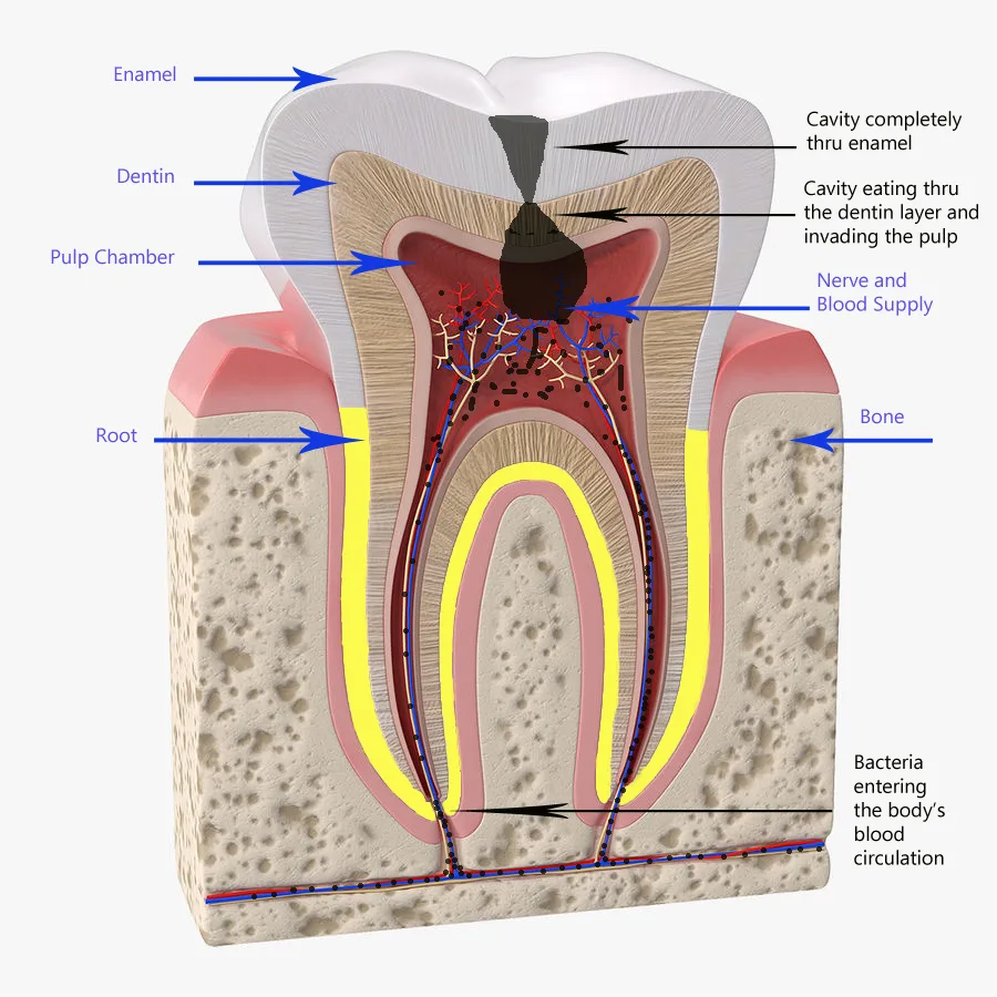 Image of tooth with decay and bacteria in pulp invading the bloodstream