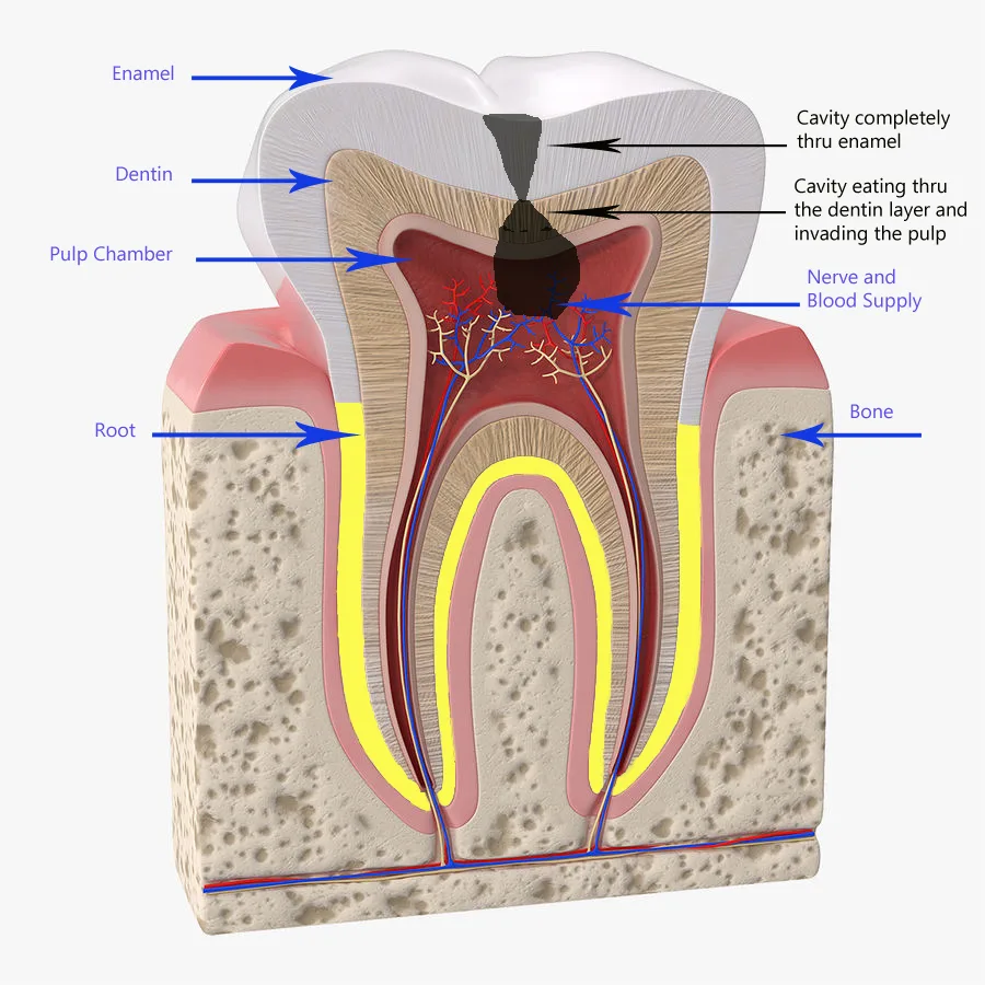 Image of tooth decay and cavity extending into the pulp layer of the tooth