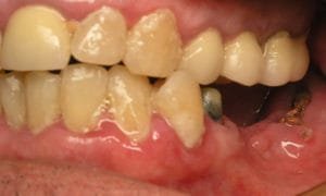 Picture of patient with advanced periodontitis and gum abscess and infection