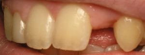 Picture of patient with congenitally missing lateral incisor tooth