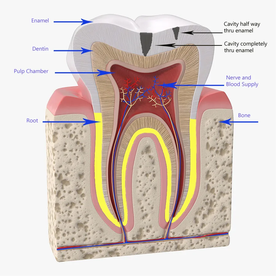Most Common Teeth Diseases Image of tooth with cavity in enamel layer depicting teeth disease