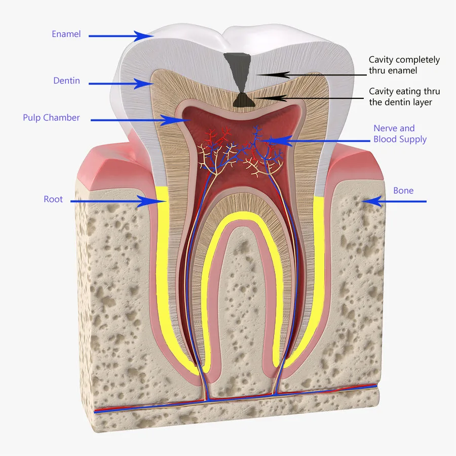 Most Common Teeth Diseases Image of tooth with decay invading the enamel and dentin layers