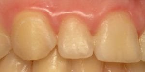 picture of gums with gingivitis making the gums look puffy and bloated