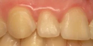 Most Common Teeth Diseases picture of gums with gingivitis making the gums look puffy and bloated