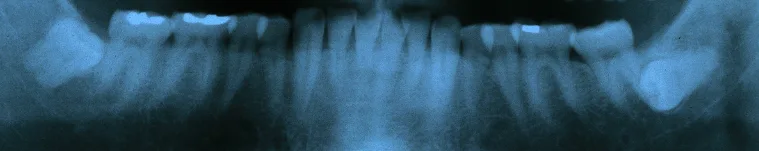 Most Common Teeth Diseases x-ray showing wisdom teeth are impacted on the bottom jaw