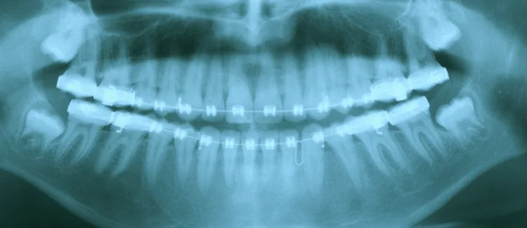 Most Common Teeth Diseases x-ray of jaw showing straight wisdom teeth